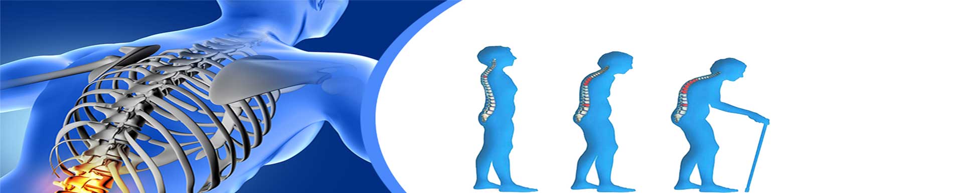 osteoporosis en personas